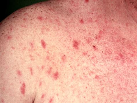 <b>HIV</b> <b>rash</b> Image source: medicalnewstoday. . Hiv rash pictures